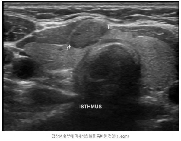 황금빛 Dr. 갑상선암 진단 사례 안내 이미지
