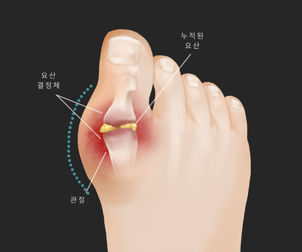 요산수치 높으면 나타나는 증상, 통풍 전 단계일 수도 있습니다 안내 이미지