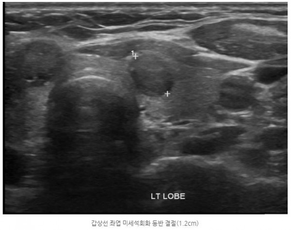 황금빛 Dr. 갑상선암 진단 사례 안내 이미지