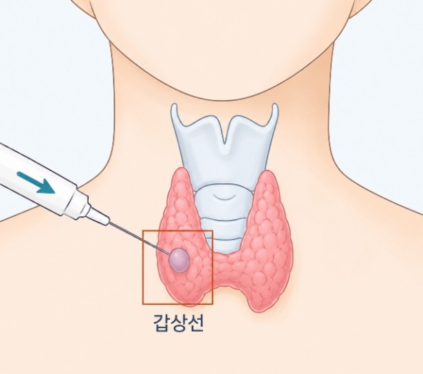 갑상선 결절, 조직검사가 필요한 경우는 언제일까요? 안내 이미지